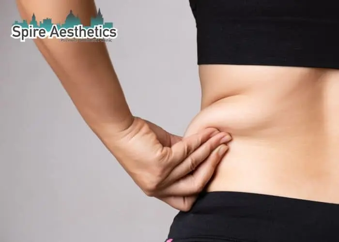 Image of woman pinching fat on their hips Eccleshill. Fat Freezing treatment