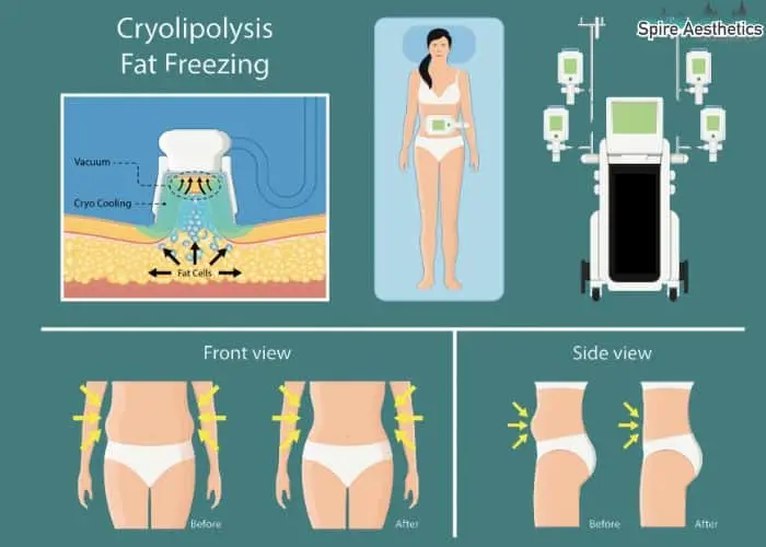 Fat freezing treatment Eccleshill benefits for competitions to remove stubborn fat deposits.