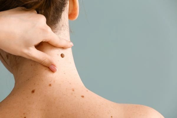 skin blemish removal Eccleshill treatment